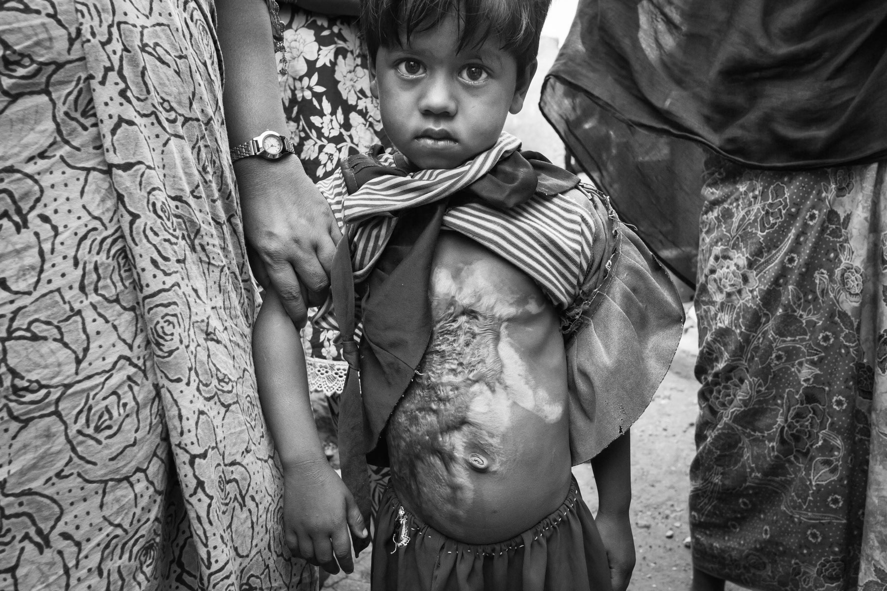 Four year old girl with severe burn injuries. Being stateless and having no status in India, the Rohingya refugees have no or only very limited access to primary health care and can not afford the treatments. Balapur camp, Hyderabad, India, June 2016