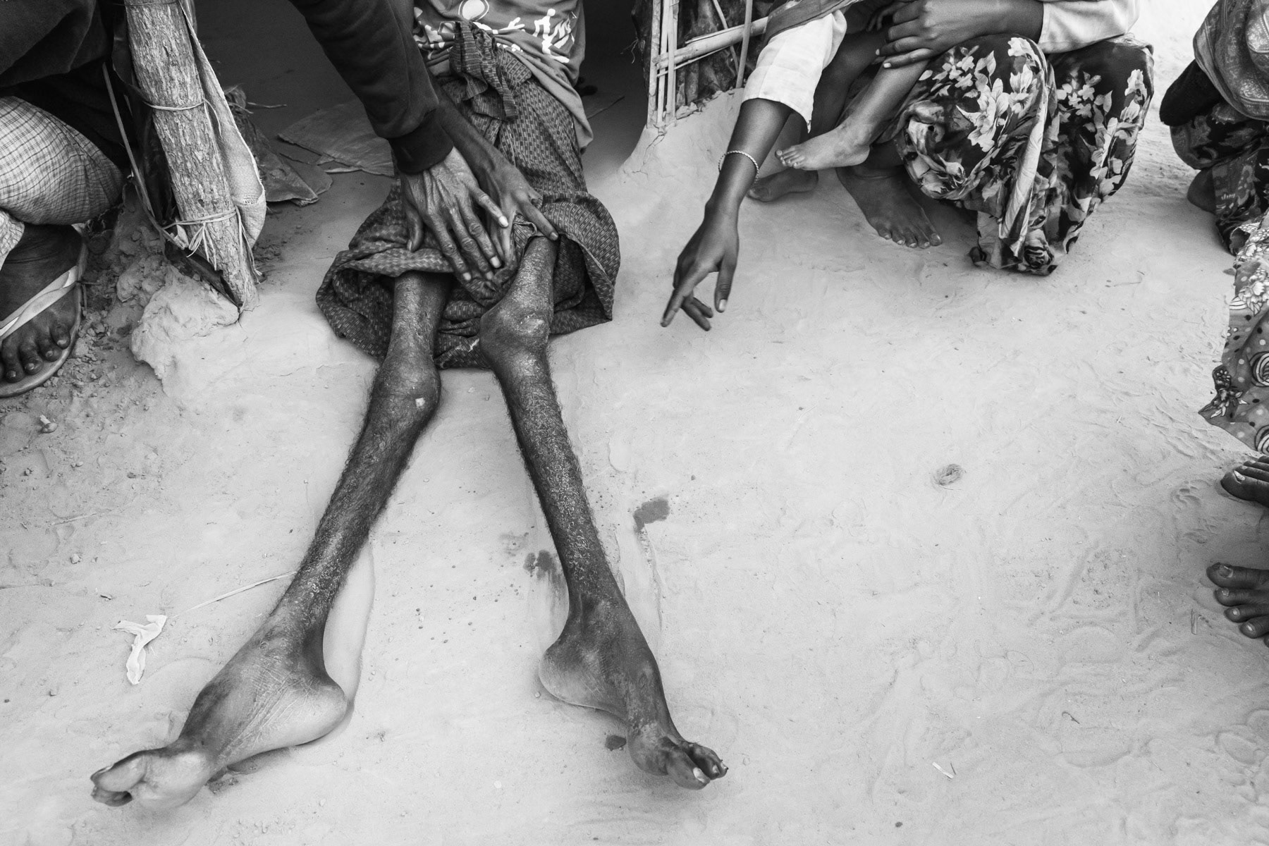 A Rohingya refugee that has recently arrived in Bangladesh with his wife and 5 children. He was an Imam in Myanmar and was tortured in November by the army for days after his legs were broken with metal bars. He was carried into the country. Kutupalong new refugee camp, Cox's Bazar district, Bangladesh, February 2017