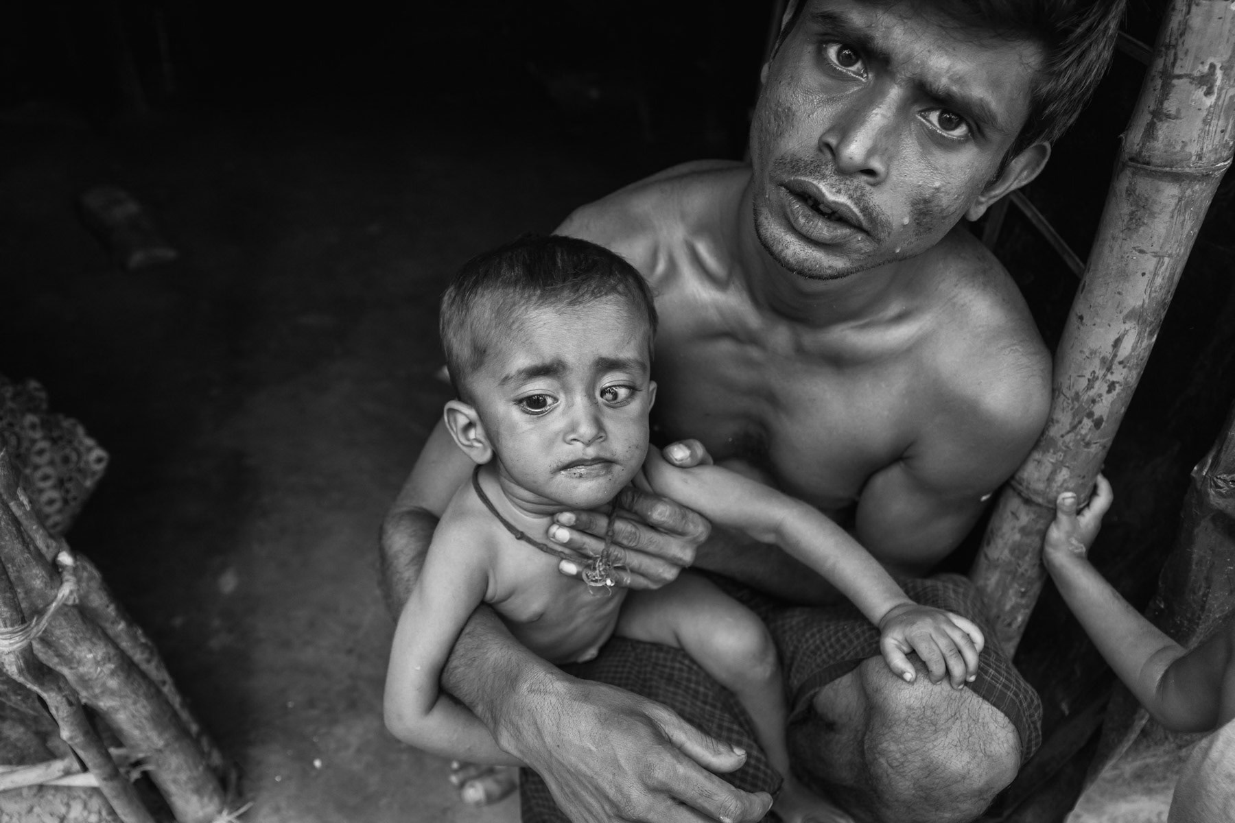 Rohingya child with an eye infection and his father have recently arrived from neighbouring Myanmar as refugees. Lambashiya section of Kutupalong refugee camp, Ukhiya, Bangladesh, November 2017