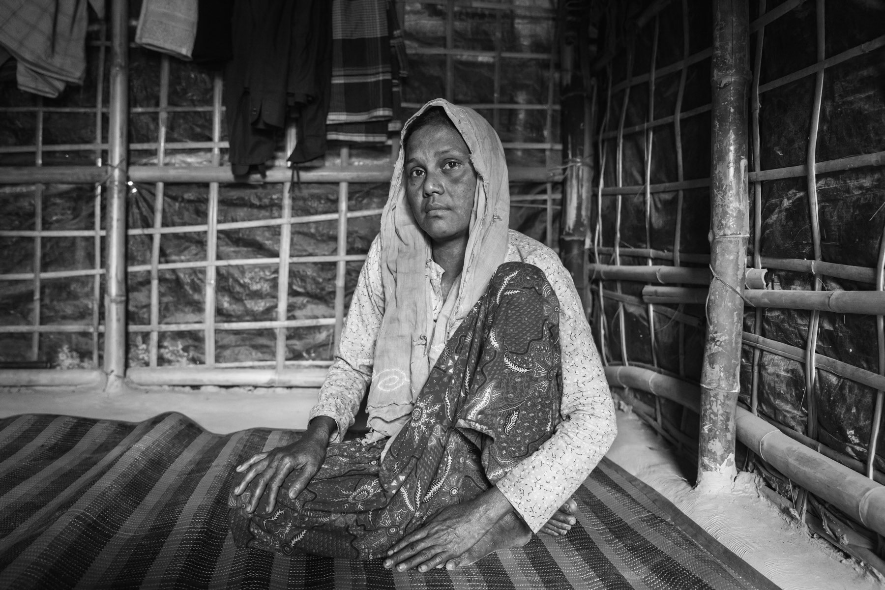 Shaju Begun, 40 years, from Chut Pyin near Rathedaung in Myanmar. Her husband, 2 daughters and 2 sons were killed when their village was attacked. While going inside the burning house to safe her younger children she got burned all over her body. She escaped from the fire and collapsed in the paddy fields where two of her surviving younger children found her. They fled to Bangladesh after that. Chut Pyin village is one of the numerous Rohingya villages that have been totally wiped out and where severe acts of ethnic cleansing with genocidal intend have been committed by the military and local mobs. Hundreds of Rohingya have been massacred in this village alone. Tangkhali camp, Bangladesh, March 2018