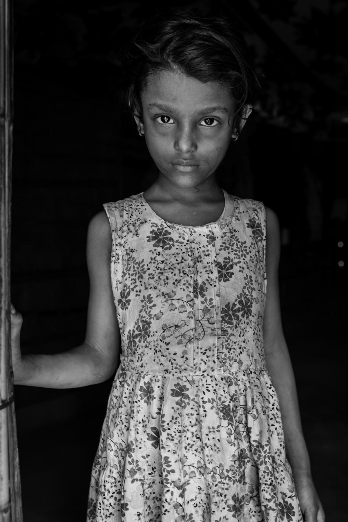 I met Azida, a Rohingya child, back in November 2017 when she was dying of battery acid poisening, acid that was forcibly given to her by military and Rakhine mobs. She is now looking much better and gained weight. She can now eat more diverse food but in very small quantities otherwise she still has frequently vomits and her digestive system is still very fragile. Balukhali refugee camp for Rohingya refugees, Bangladesh, October 2018