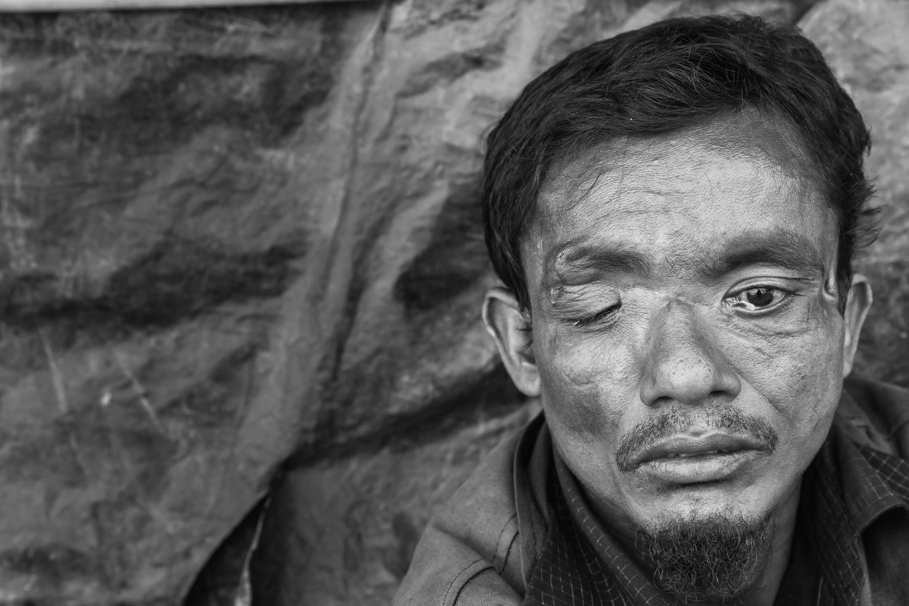 Rohingya refugee that arrived end December 2016 with his wife and five children. He was tortured and attacked with a machete and is blind on one eye. Kutupalong refugee camp, Cox's Bazar, Bangladesh, February 2017