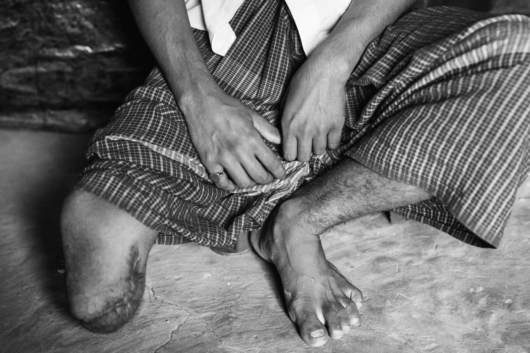 Shangi Alam is a 17 years old Rohingya from Maungdaw in Myanmar. He has been shot in the leg by military forces during the first unrest in October 2016. Due to a lack of medical care the wound got infected and his leg amputated. He fled to Bangladesh in September 2017 after his village got burnt down. Kutupalong camp, Bangladesh, November 2017