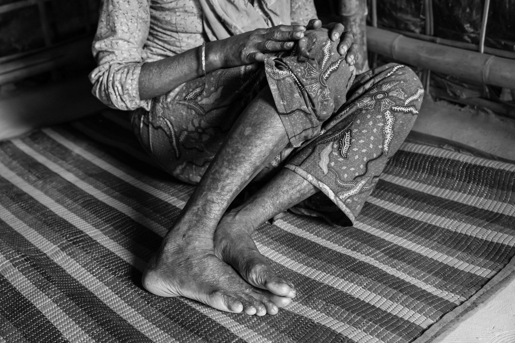 Shaju Begun, 40 years, from Chut Pyin near Rathedaung in Myanmar. Her husband, 2 daughters and 2 sons were killed when their village was attacked. While going inside the burning house to safe her younger children she got burned all over her body. She escaped from the fire and collapsed in the paddy fields where two of her surviving younger children found her. They fled to Bangladesh after that. Chut Pyin village is one of the numerous Rohingya villages that have been totally wiped out and where severe acts of ethnic cleansing with genocidal intend have been committed by the military and local mobs. Hundreds of Rohingya have been massacred in this village alone. Tangkhali camp, Bangladesh, March 2018