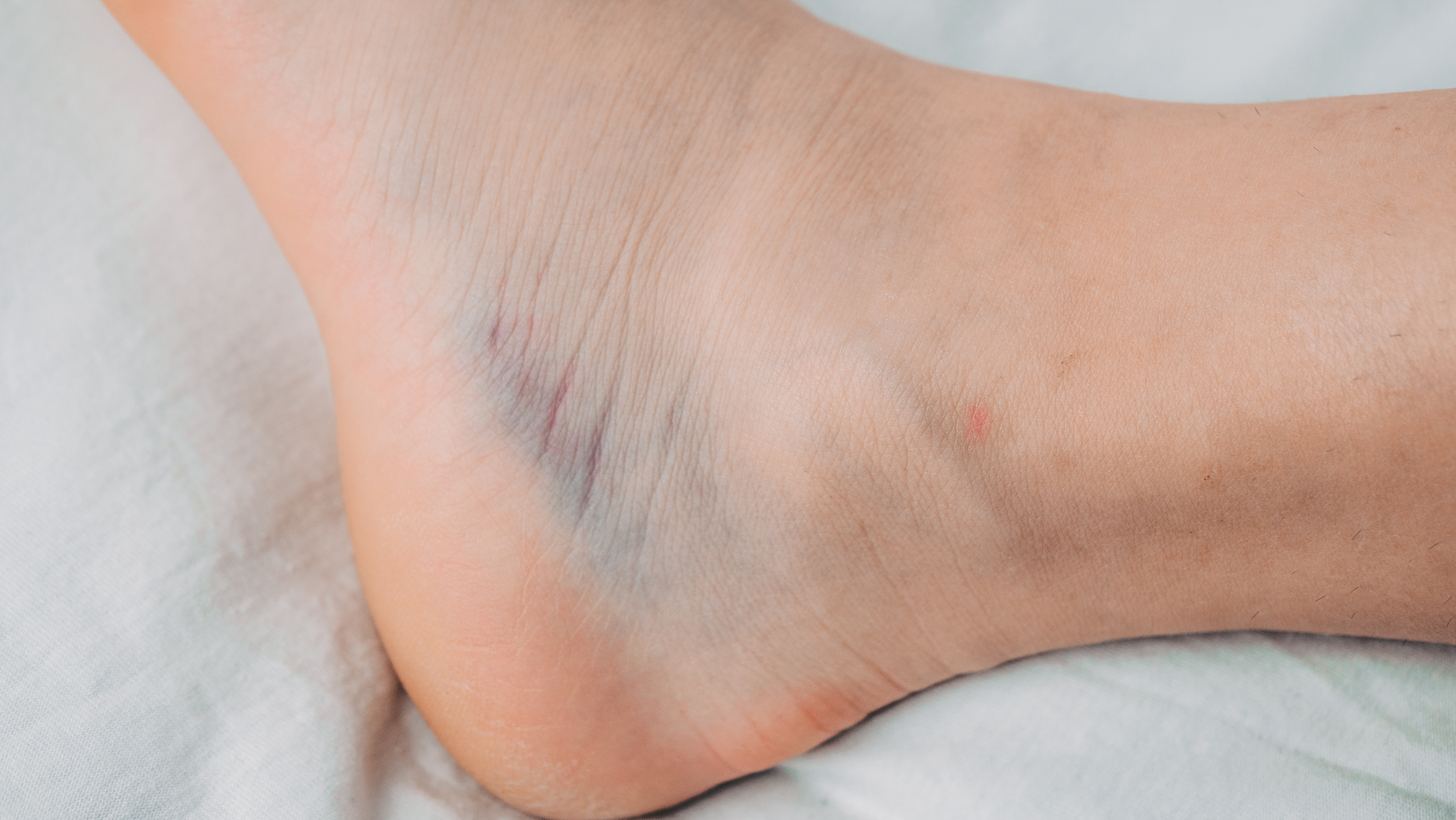 Infiltração com ácido hialurônico para tendões e ligamentos