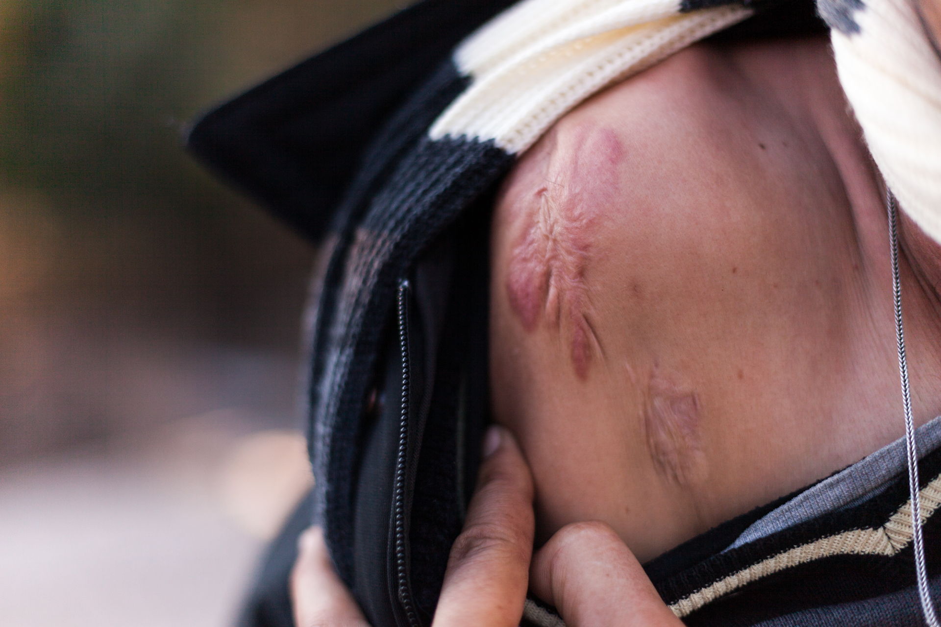 A refugee who used to be an Iranian political prisoner shows me the scars he got while escaping the prison he was kept in.