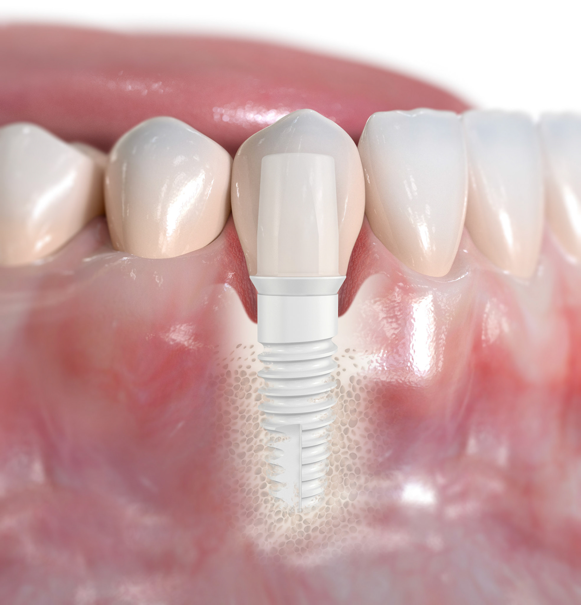 Client: Nobelbiocare