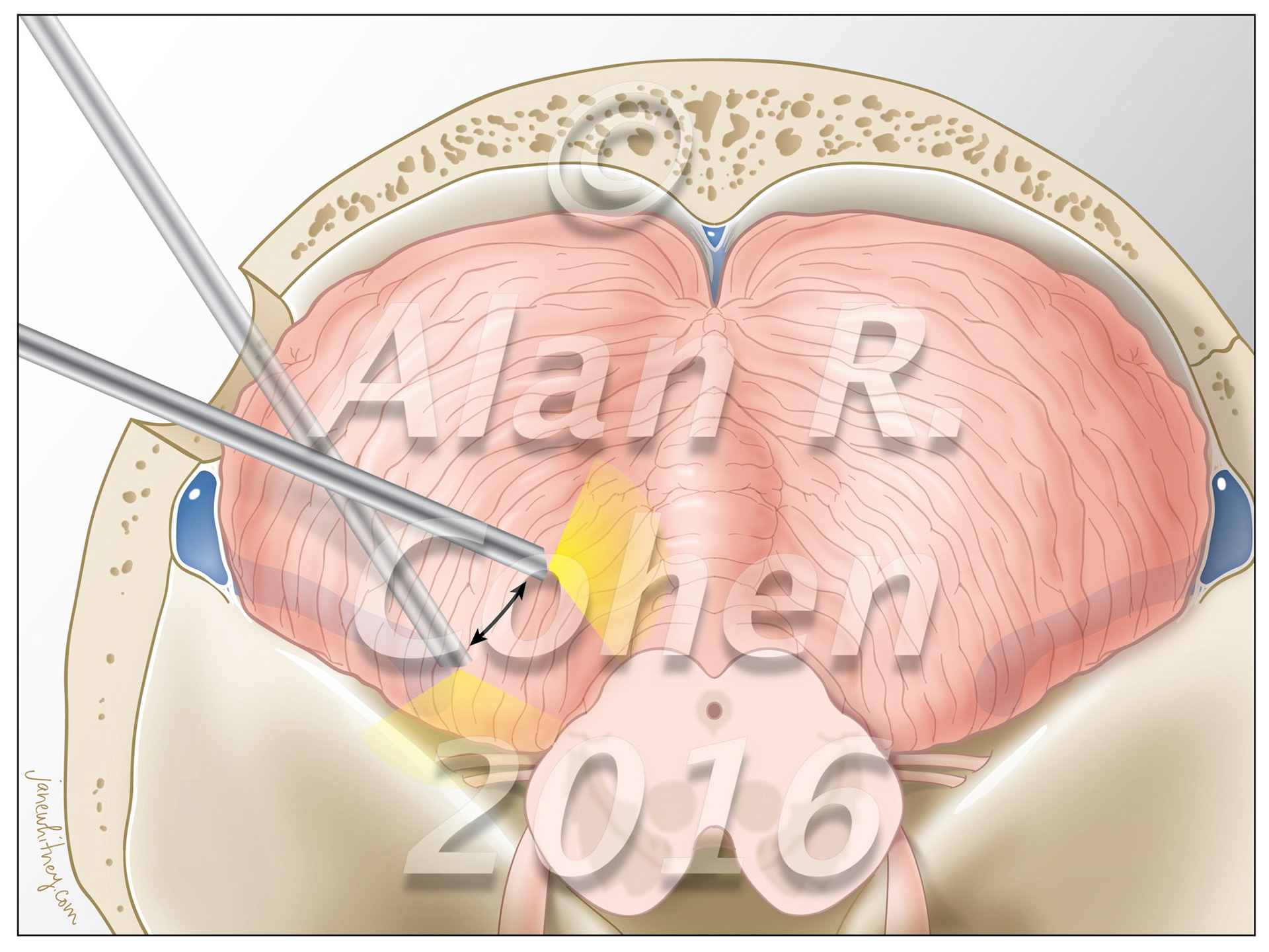Despite recent technological advances, direct approaches to the posterolateral incisural space remain surgical challenges. The extreme lateral infratentorial supracerebellar approach to treat pathologies located in the ambient cistern and posterior incisural space is a technically feasible route in selected cases. World Neurosurgery, July 2016 https://doi.org/10.1016/j.wneu.2016.04.017