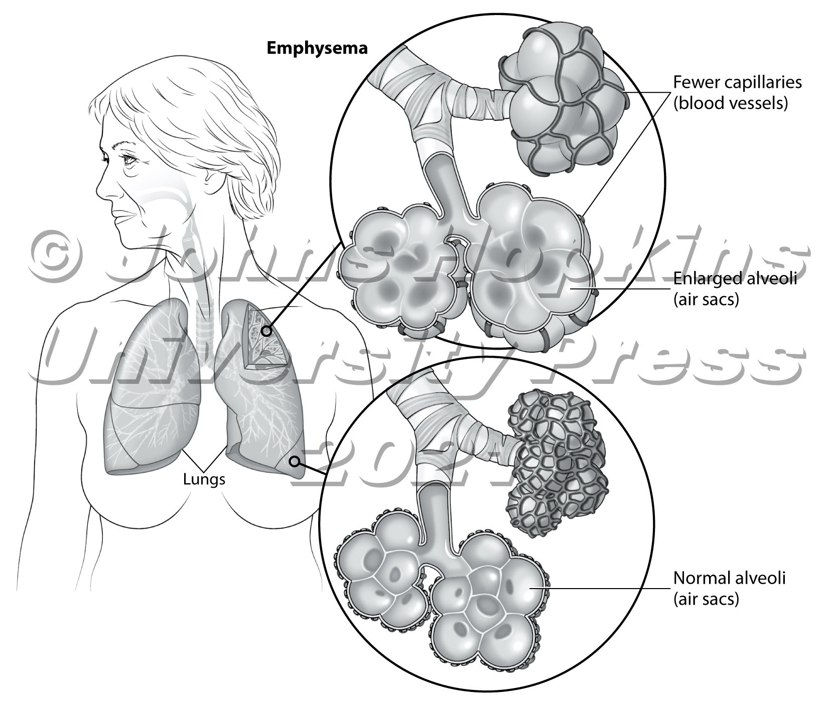 Emphysema: changes in alveoli