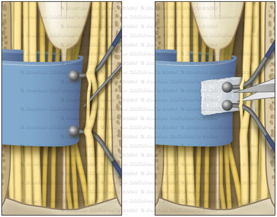 The nerves are each tested with small electrical probes. A small rootlet is isolated and cut.