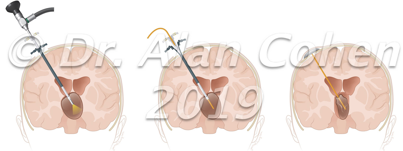 Tube within tube procedure
