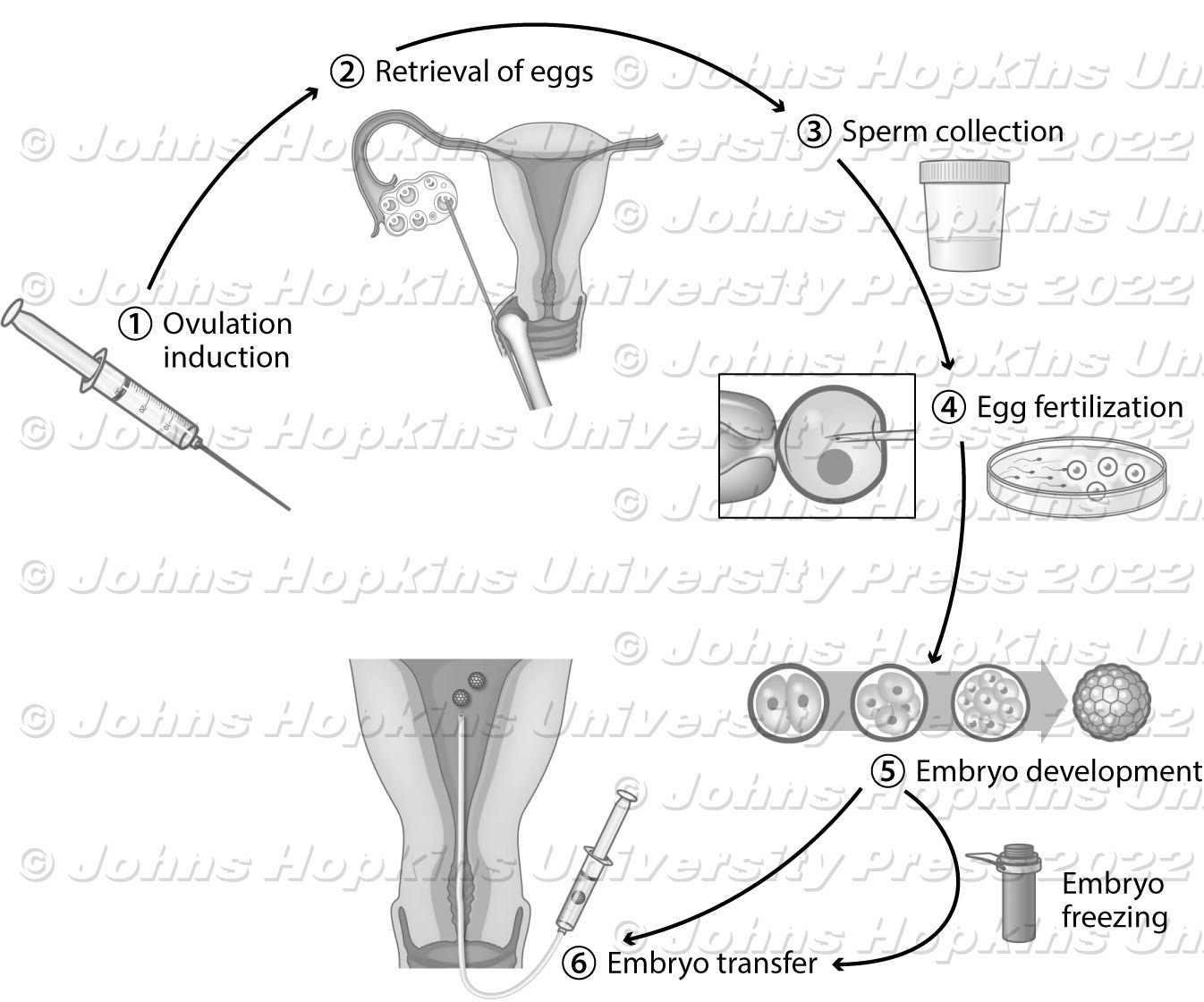 Assisted reproductive technology IVF