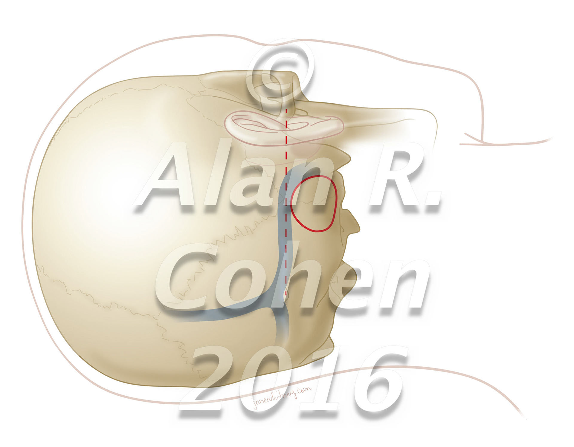Despite recent technological advances, direct approaches to the posterolateral incisural space remain surgical challenges. The extreme lateral infratentorial supracerebellar approach to treat pathologies located in the ambient cistern and posterior incisural space is a technically feasible route in selected cases. World Neurosurgery, July 2016 https://doi.org/10.1016/j.wneu.2016.04.017