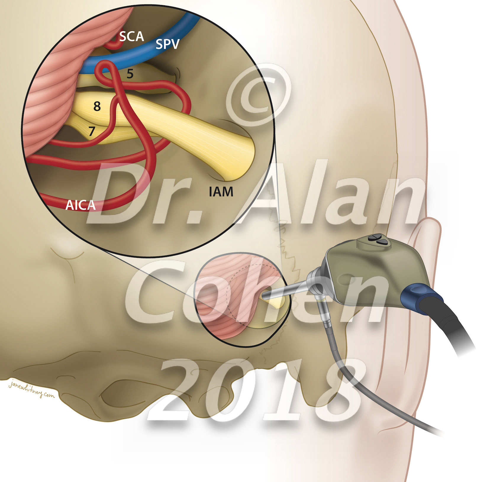 Endoscope-assisted microsurgery of the posterior fossa. Cerebellum is retracted; retractor not shown. SCA: superior cerebellar artery. SPV: superior petrosal vein. AICA: anterior inferior cerebellar artery. IAM: internal acoustic meatus.