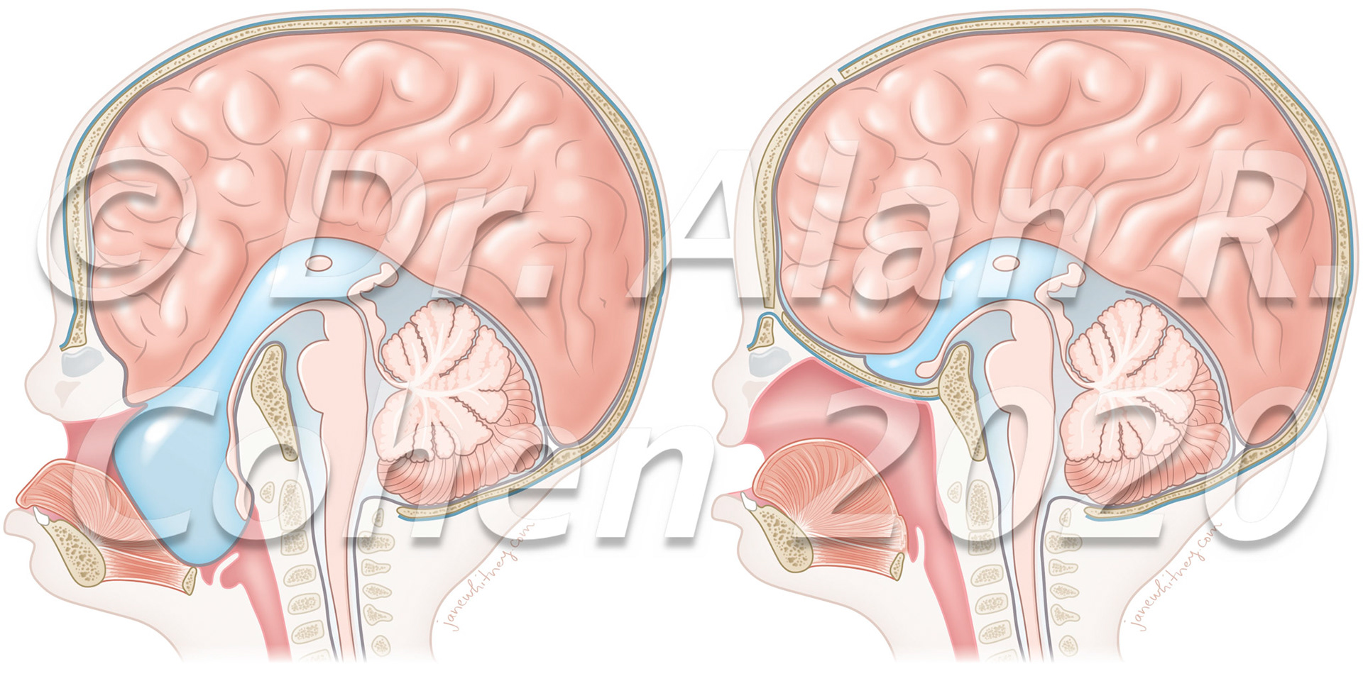 Before (left) and after (right) of a large encephalocele (herniation of meninges and brain) through the base of the anterior skull into the mouth.