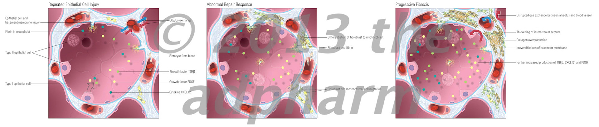 Progression of Idiopathic Pulmonary Fibrosis