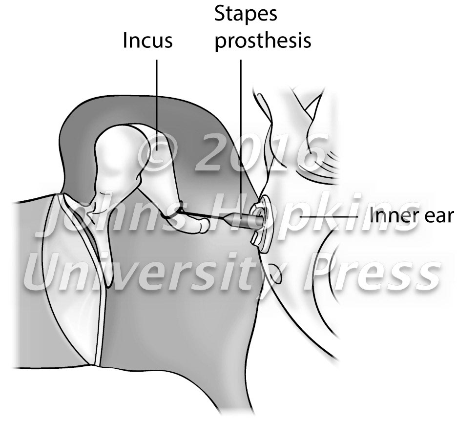 Stapedotomy