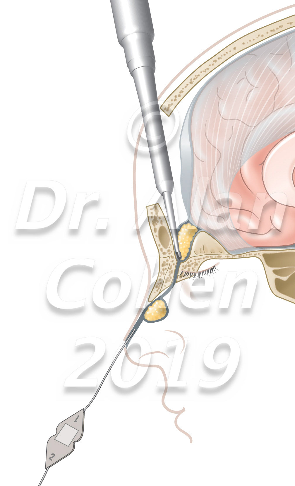 Meet in the middle technique. The neurosurgeon removes the intracranial cyst and sinus tract working through a small bifrontal craniotomy and drilling through the foramen cecum. The plastic surgeon excises the nasal punctum and uses an external rhinoplasty to remove the extracranial lesion. Child's Nervous System, 2020 https://doi.org/10.1007/s00381-020-04499-5