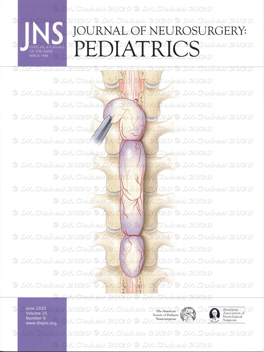Spinal extradural arachnoid cysts (SEACs) are uncommon spinal lesions that may cause myelopathy, most frequently in the 2nd decade of life. Three contiguous but separate spinal cysts were identified intraoperatively, and they were completely excised with closure of the dural defects. The patient recovered motor and sensory function of the lower extremities. Journal of Neurosurgery: Pediatrics, 2020, cover