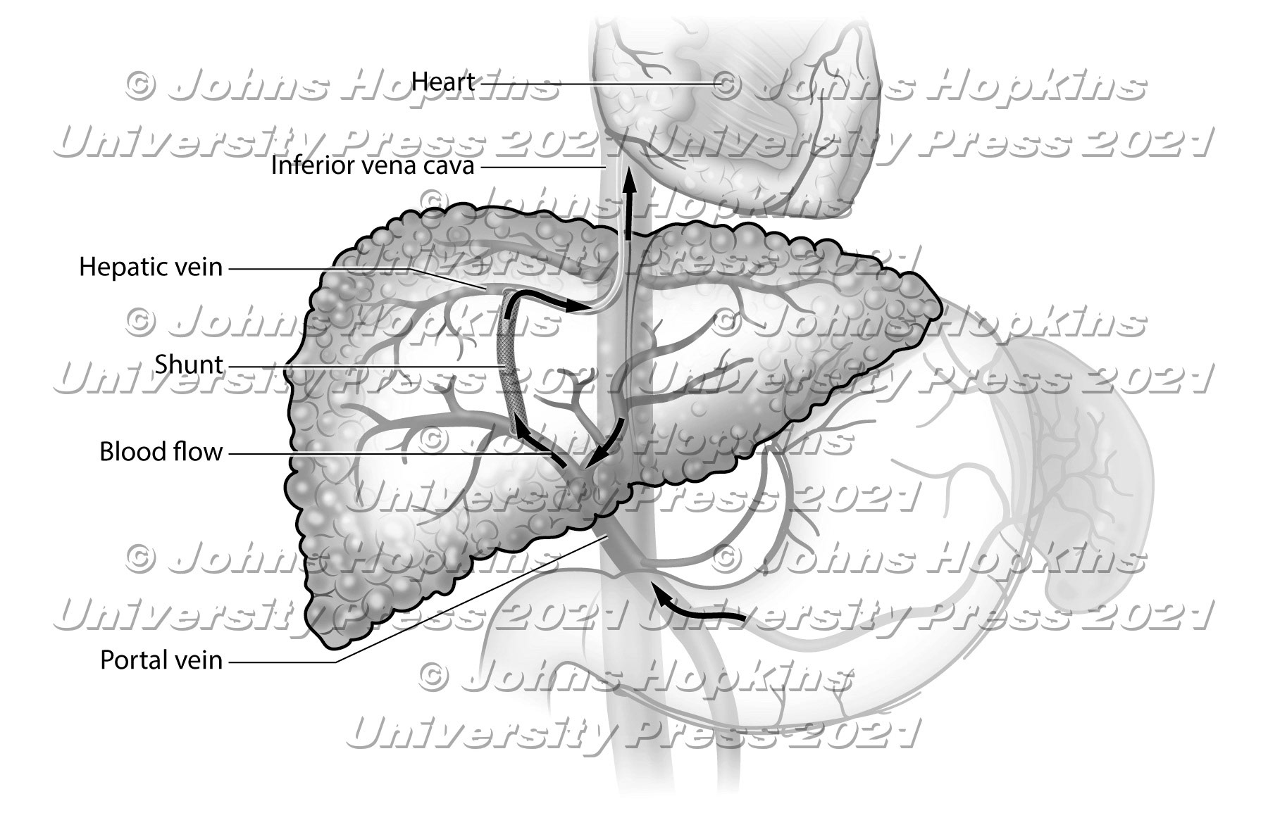Transjugular intrahepatic portosystemic shunt (TIPS or TIPSS) is an artificial channel within the liver that establishes communication between the inflow portal vein and the outflow hepatic vein. It is used to treat portal hypertension (which is often due to liver cirrhosis)