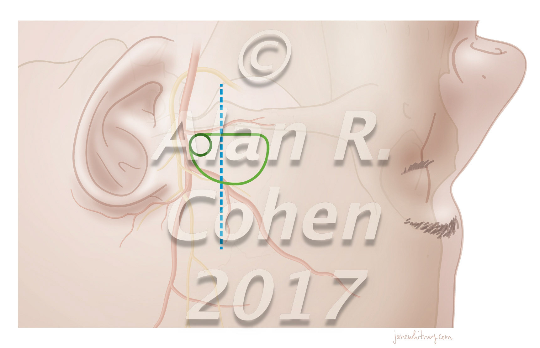 Endoscope-Assisted Microsurgical Subtemporal Keyhole Approach to the Posterolateral Suprasellar Region and Basal Cisterns World Neurosurgery July 2017 https://doi.org/10.1016/j.wneu.2017.02.054