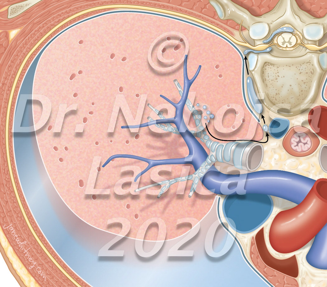 Pneumorrhachis: The most frequent initial mechanism is an increase in intraalveolar pressure (acute asthma, recurrent vomiting, or closed thoracic trauma). Barotrauma and alveolar rupture allow air migration along the bronchial tree up to the mediastinum. The collected air then separates the mediastinal pleura from the aorta and the parietal pleura from the spine; therefore, it enters the epidural space via the intervertebral foramina. The suddenness, more than the size of the pneumothorax, induces this initial increase in intra-alveolar pressure. Journal of Neurosurgery: Spine Oct 2020 https://doi.org/10.3171/2020.6.SPINE20648