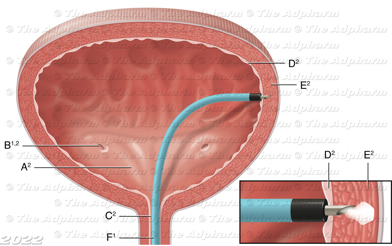 Botox treatment for overactive bladder
