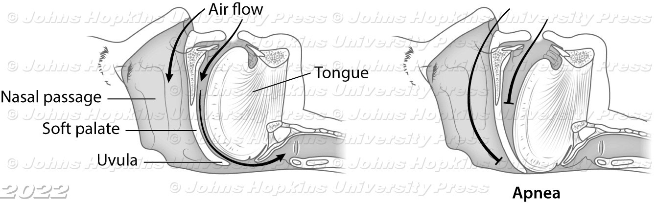 Anatomy of sleep apnea