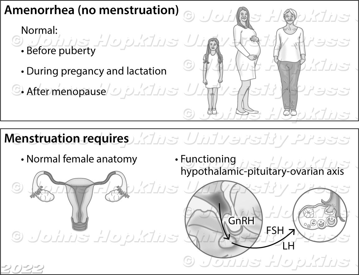 Causes of amenorrhea