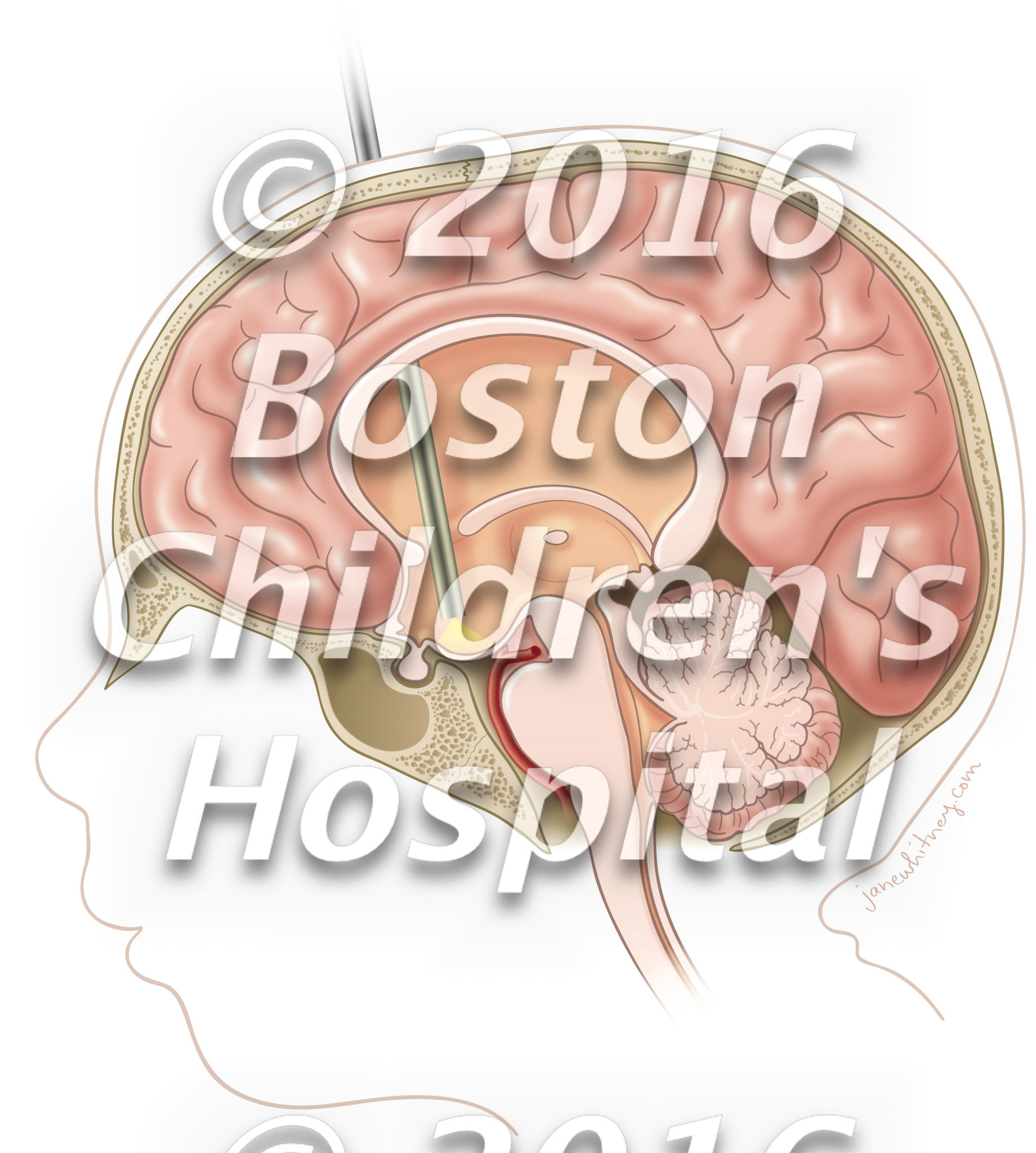 Endoscopic third ventriculostomy