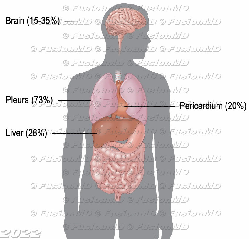 Tumor metastases locations