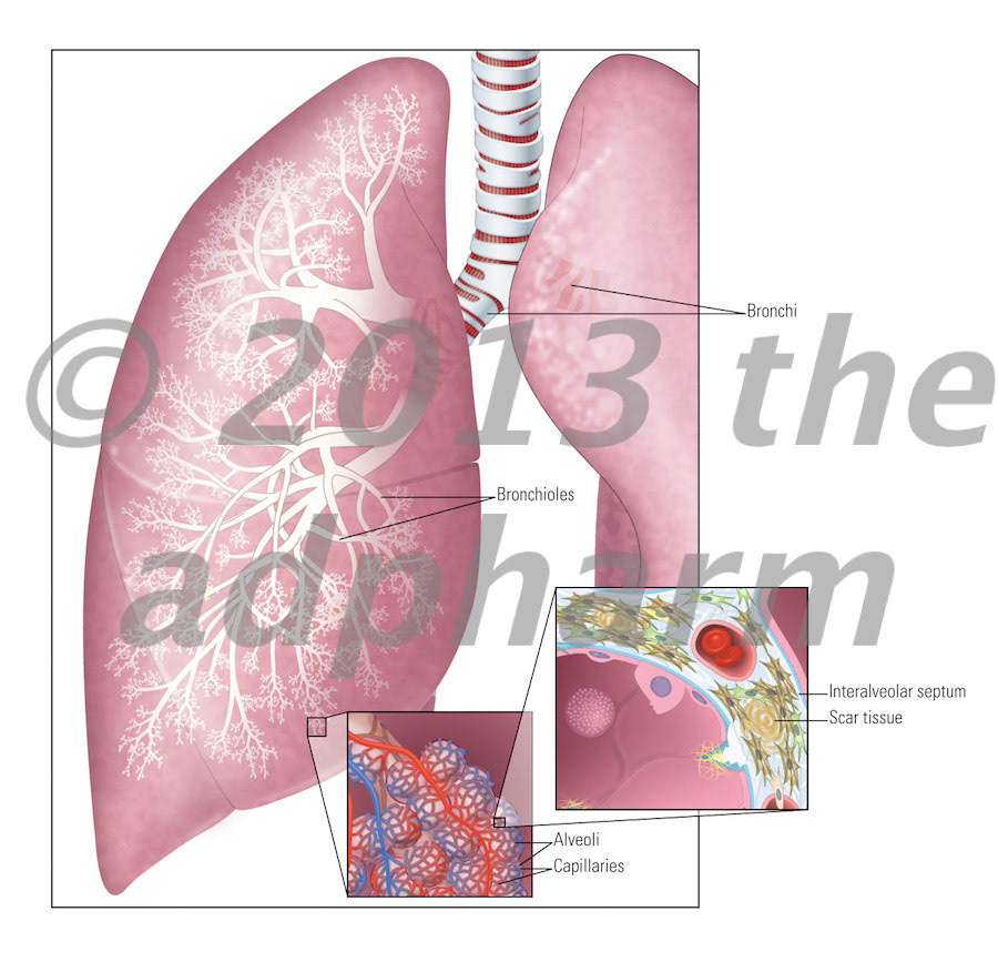 Lungs, Idiopathic pulmonary fibrosis