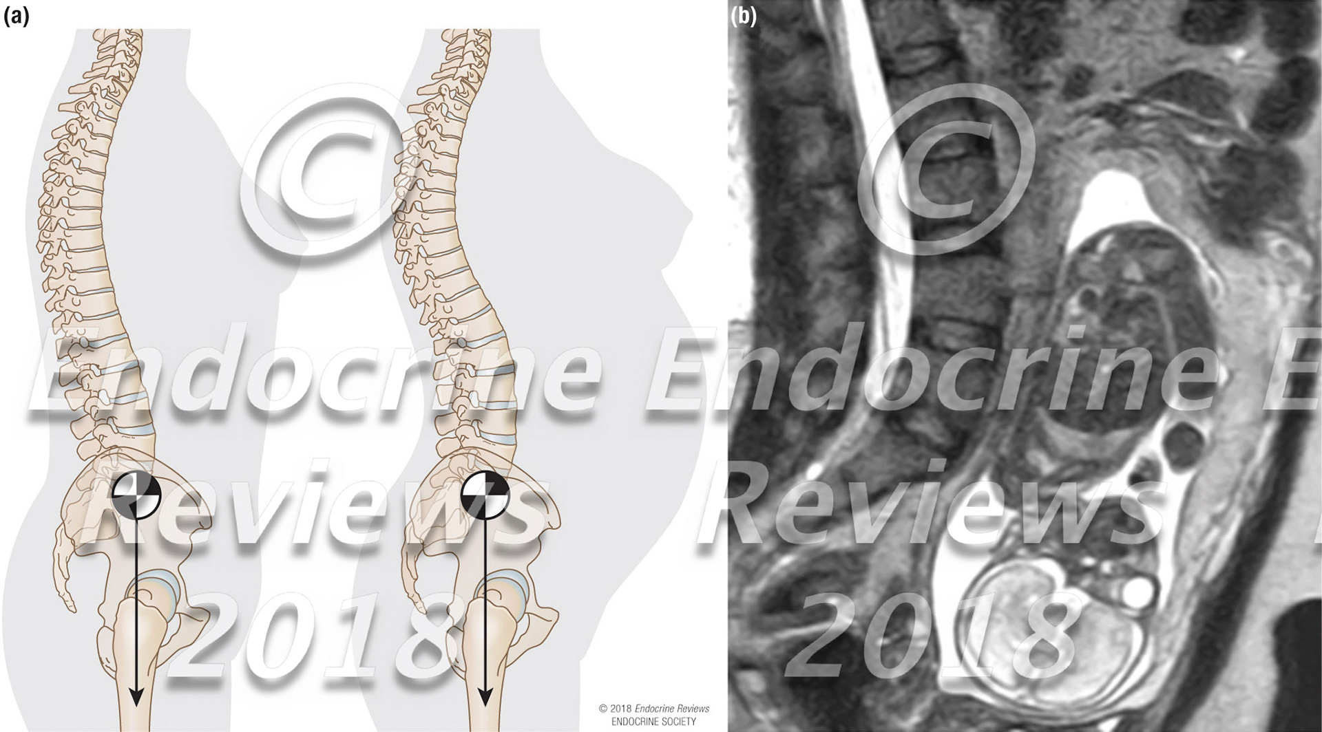 Pregnancy lumbar lordosis