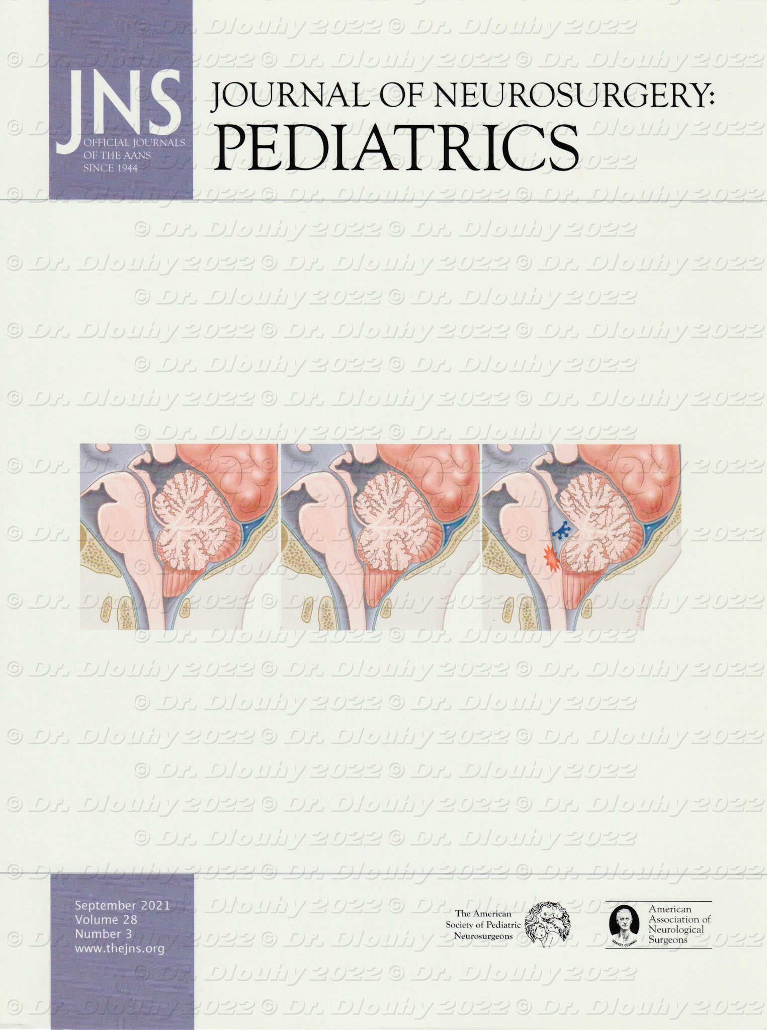 JNS Pediatrics cover 2021, Chiari malformation
