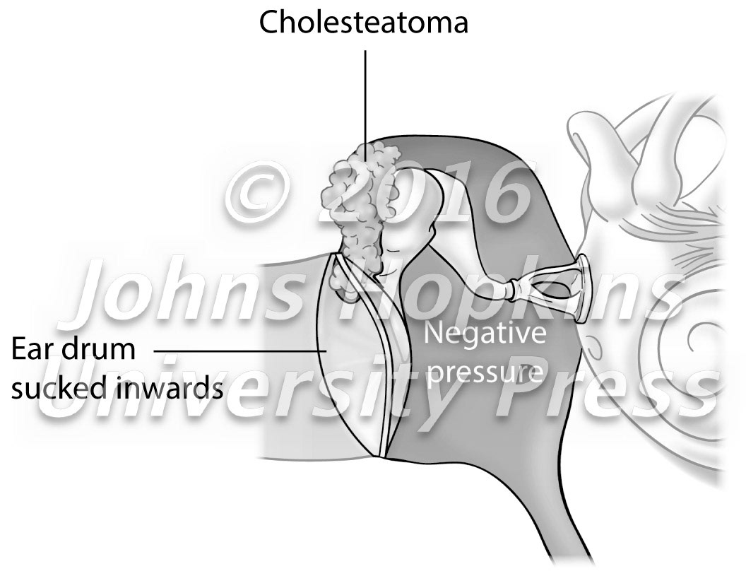 Cholesteatoma