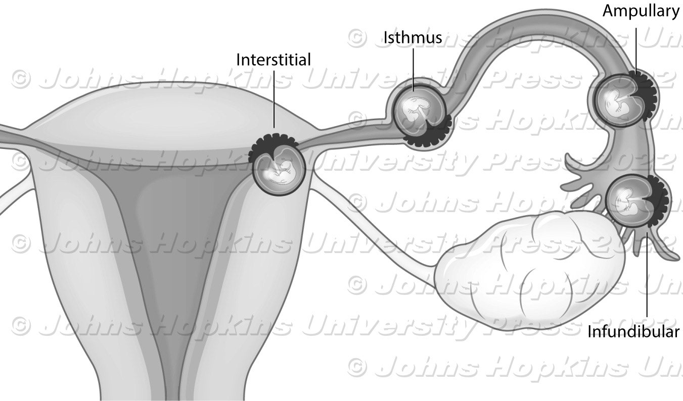 Ectopic pregnancy locations