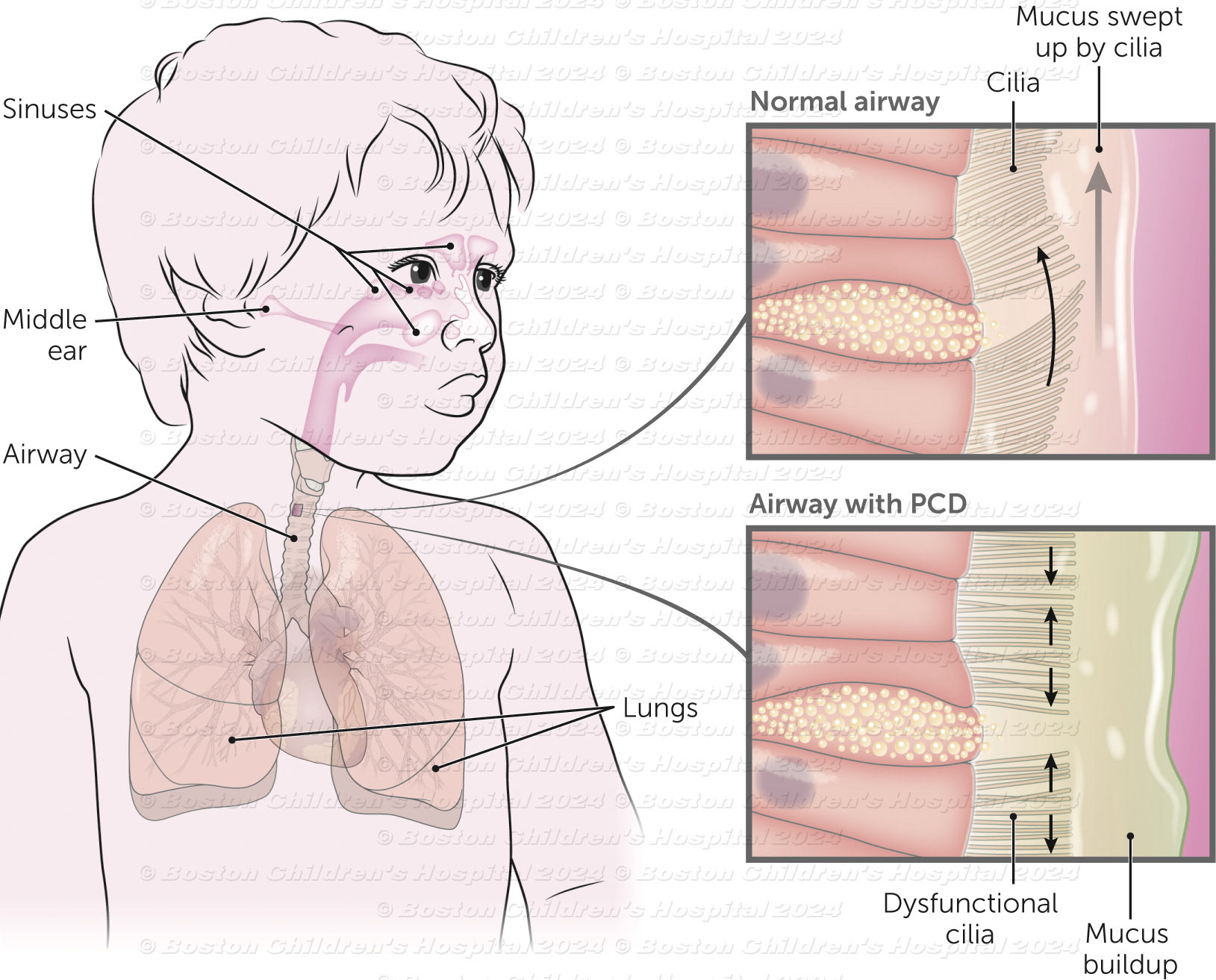 Primary ciliary dyskinesia