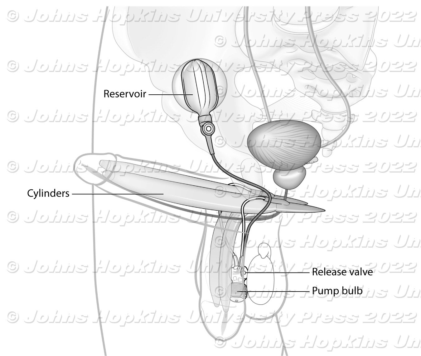Penile implant