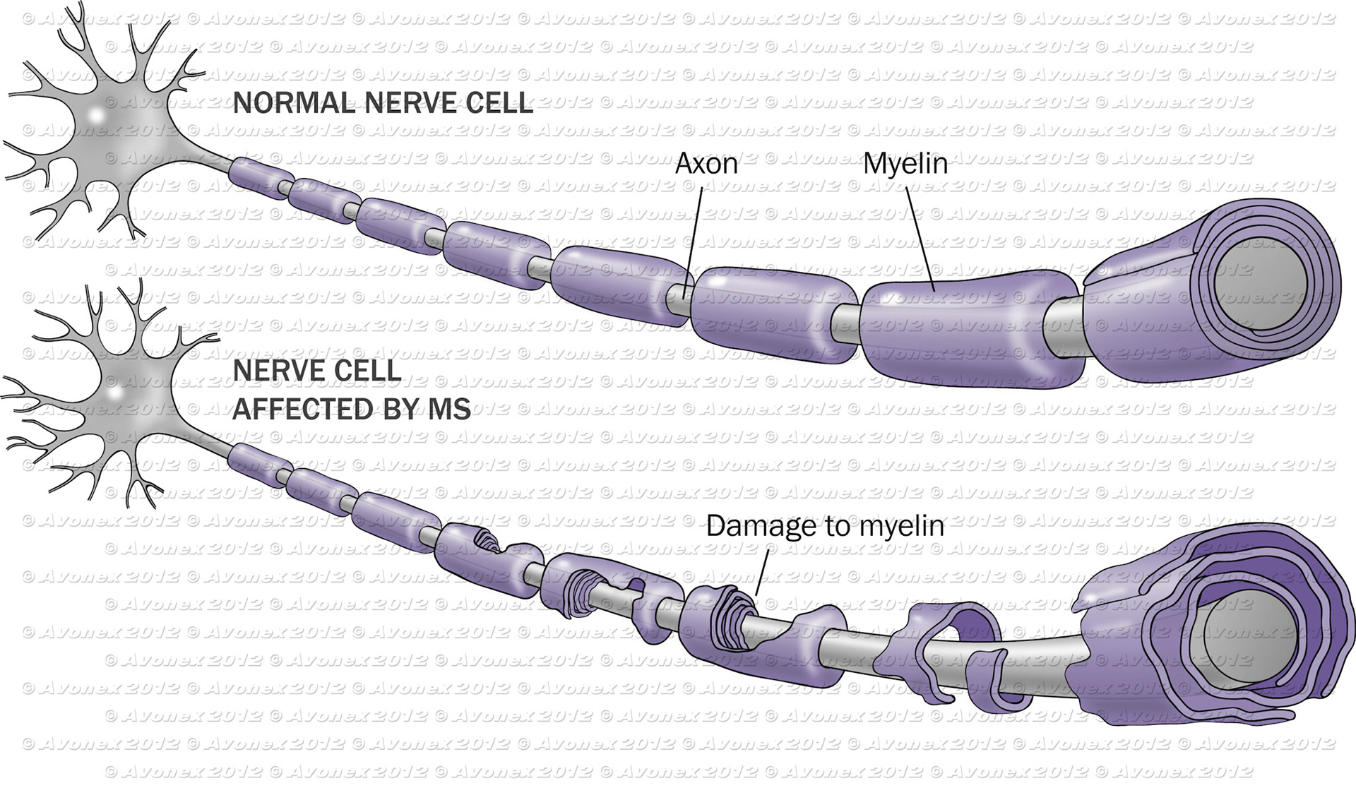 Multiple sclerosis