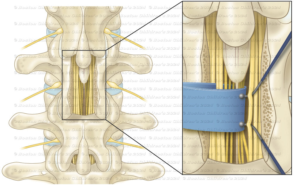 Combined Rhizotomy: a small window of bone removed in order to see the spinal nerves.