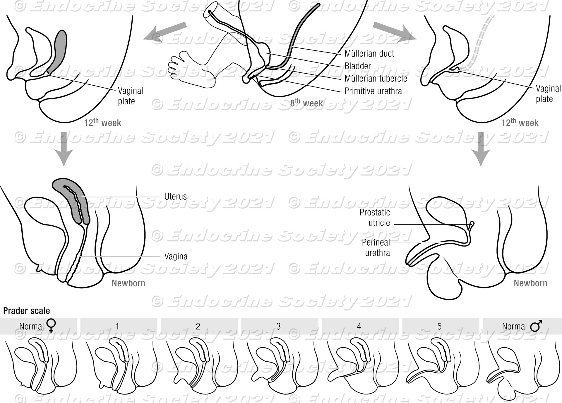 Genital development. Top, Differentiation of male and female reproductive systems are illustrated in schematic cross-section (not to scale). Bottom, the Prader scale of genital virilization.