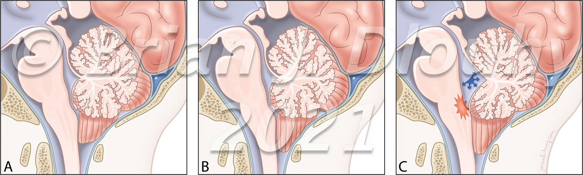 Fourth ventricle roof angle as a measure of fourth ventricle bowing and a radiographic predictor of brainstem dysfunction in Chiari malformation type I Journal of Neurosurgery: Pediatrics Sept. 2021