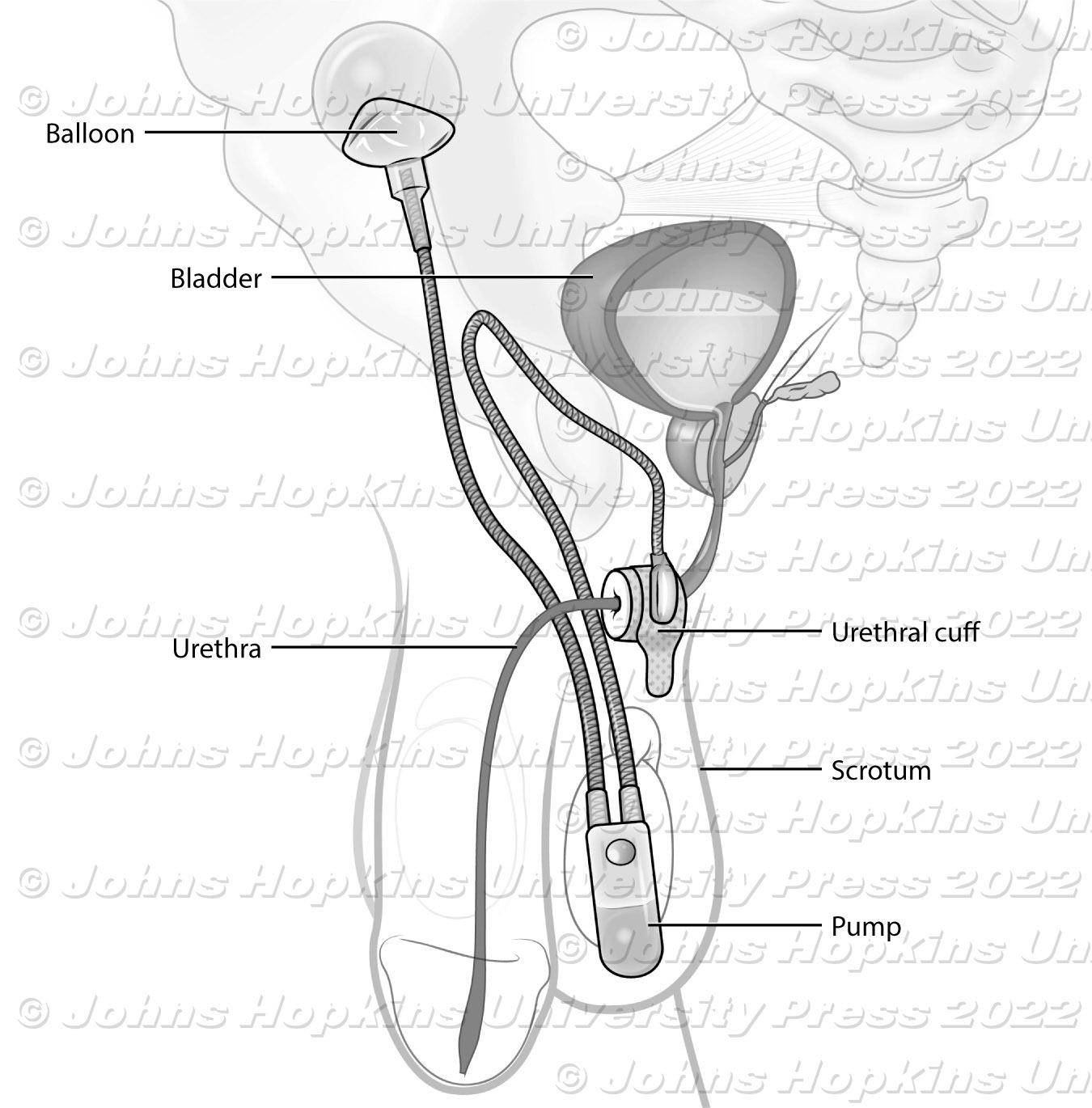 Male urethral cuff