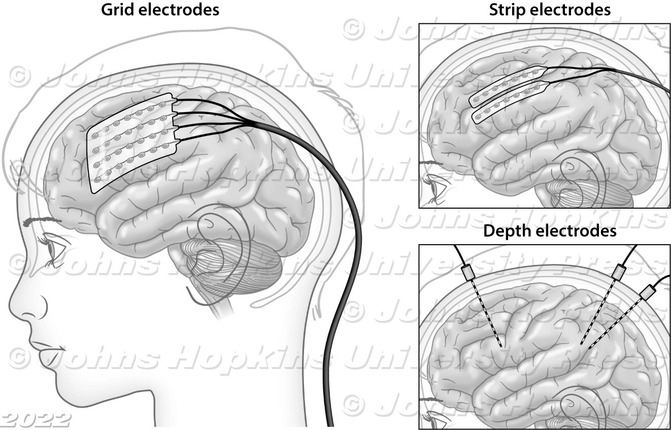 Invasive EEG monitoring for epilepsy