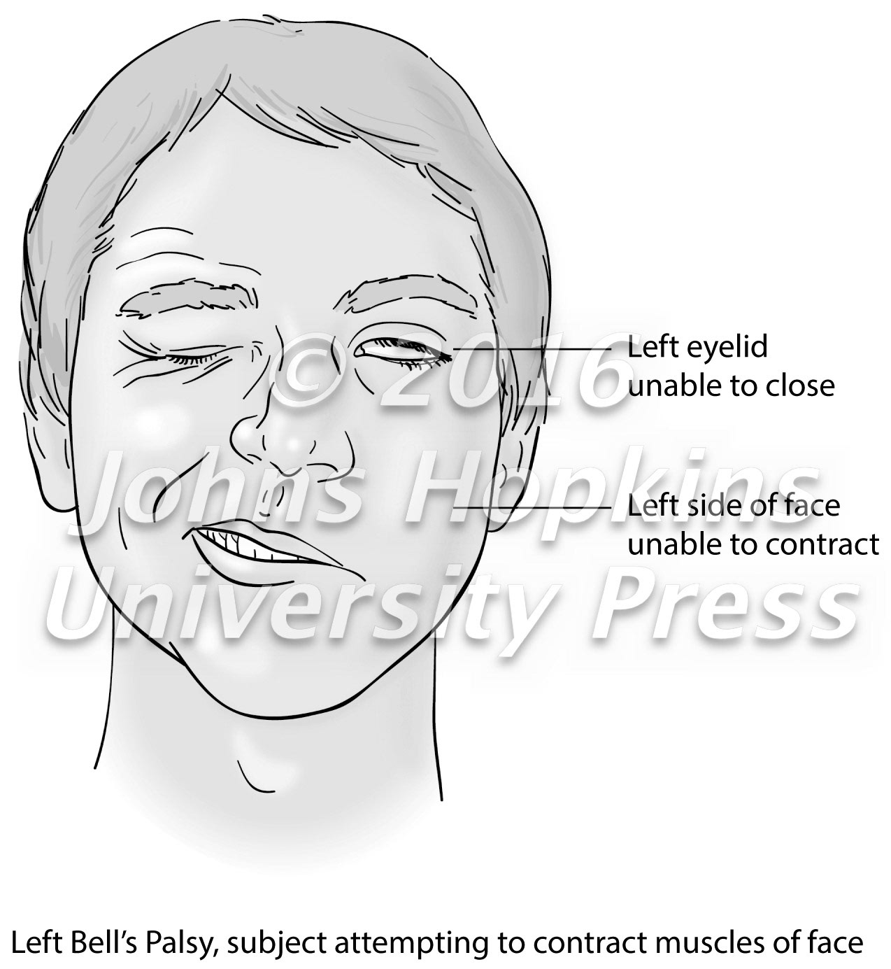 Left Bell's Palsy
