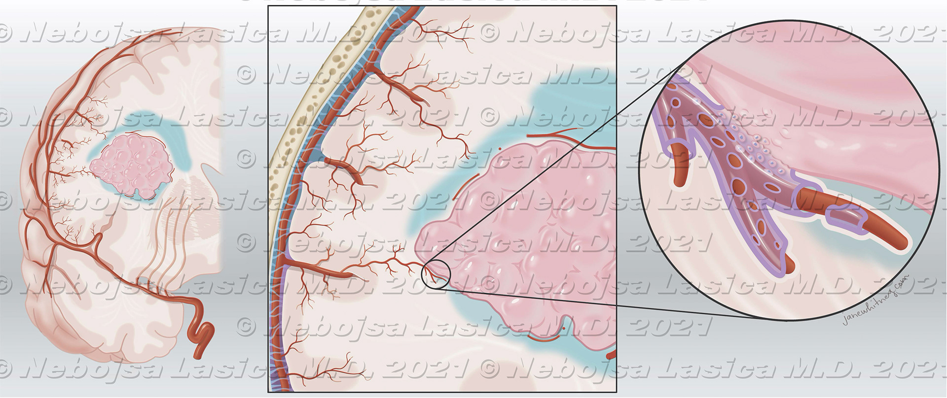 The primary intraparenchymal meningioma of thefrontal lobe (A) with no apparent dural attachment. Thepresumption is that arachnoid cells present in the pia matermigrate together with penetrating blood vessels duringbrain development (B).World Neurosurgery, Sept. 2021https://doi.org/10.1016/j.wneu.2021.06.139
