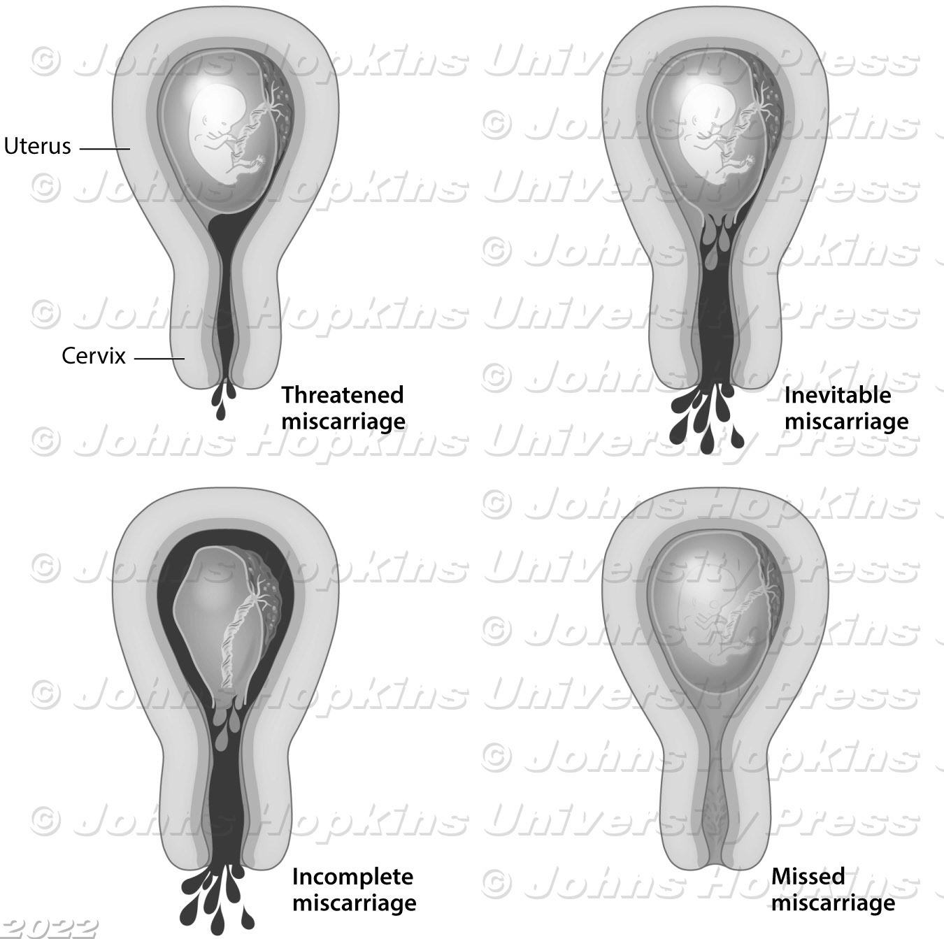 Types of Miscarriages