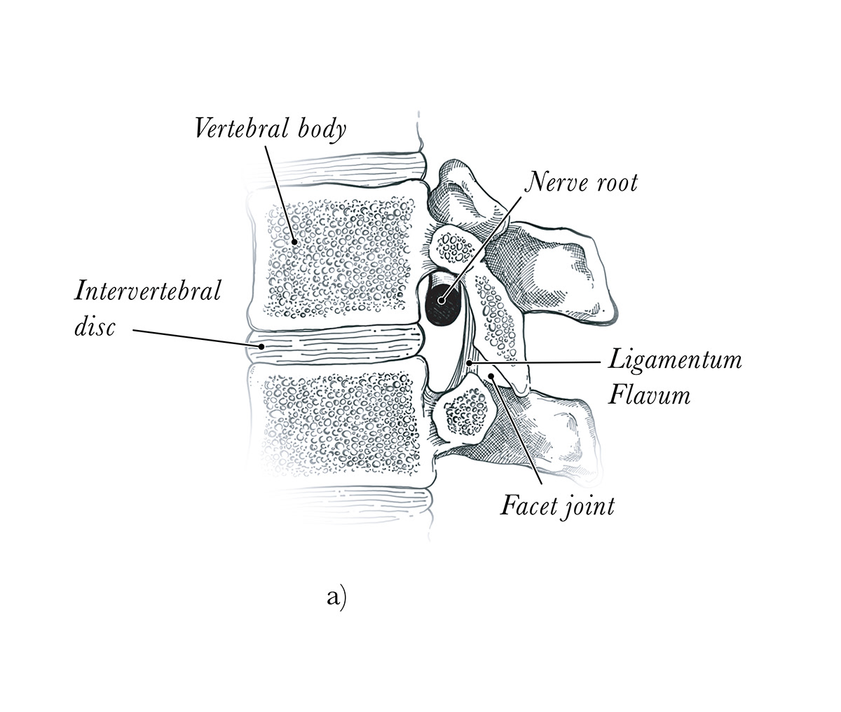 Image of a normal nerve root in the foramen