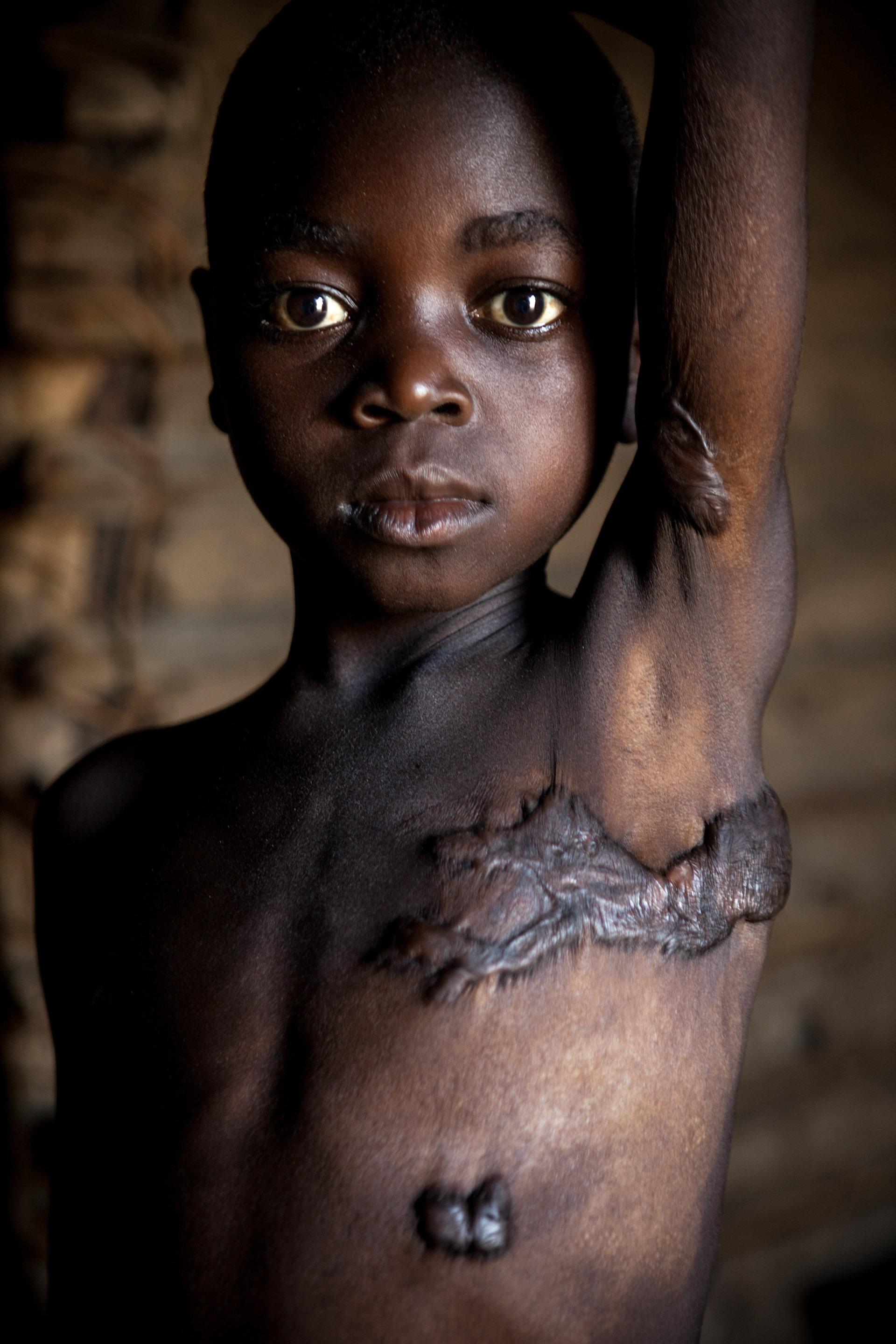 Shadrak Mabanga was not even one year old when fragments of a mortar hit his mother. While on her back, he miraculously survived the shrapnels that lodged in his chest and his left arm.