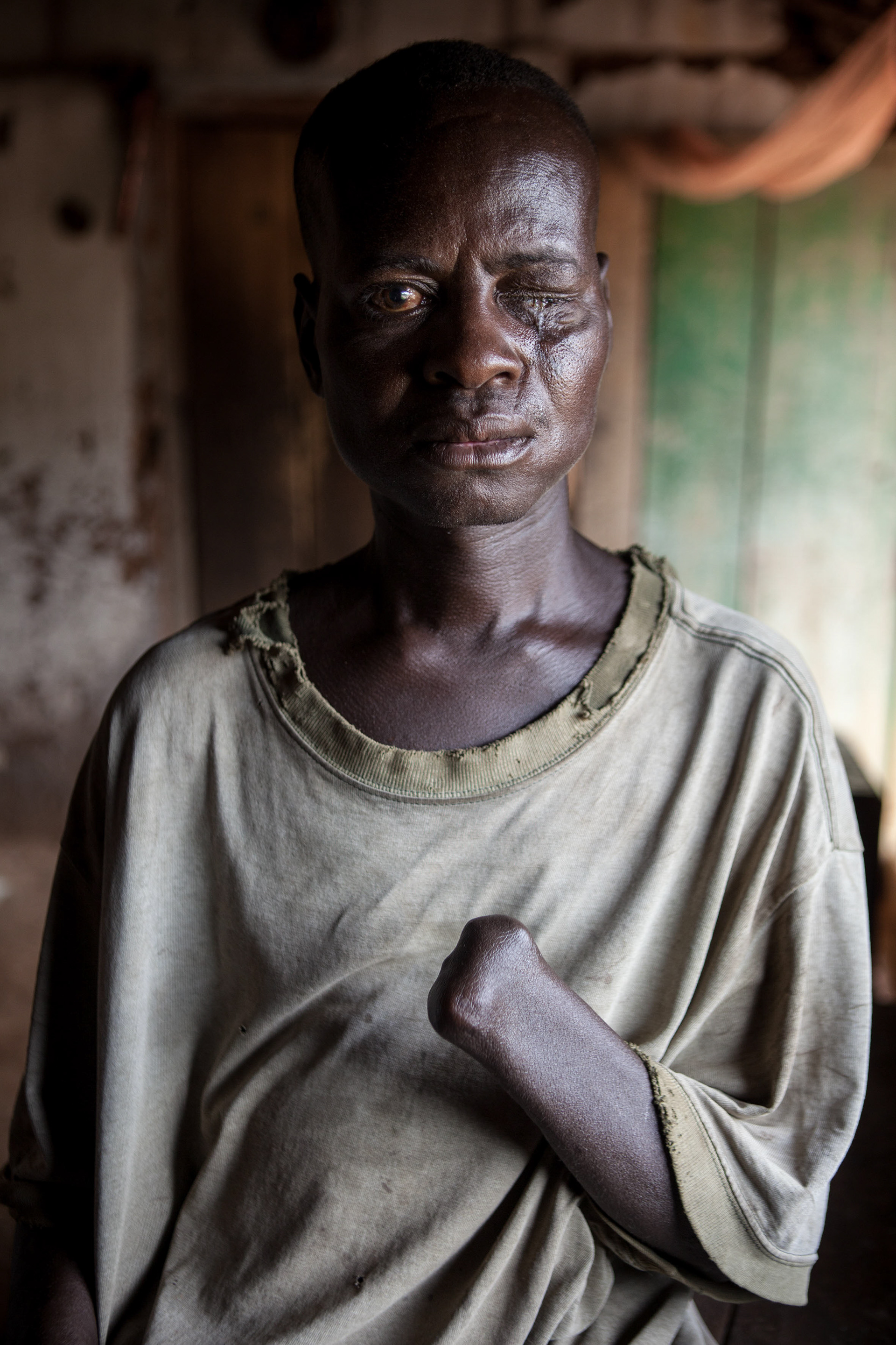 “It was the 29th of November 2001 at 2.30 in the afternoon. I was participating in a prayer group. A man brought a grenade, thinking it was a toy. He joked around with it and then the accident happened. 37 people were injured and 3 died, including the man in question and a young girl 12 years old. When I was able I tilled the fields, I did everything. Since the accident I have no way to work and my wife left me. I have become unhappy.”